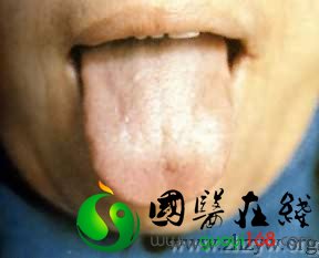 淡白舌薄白苔