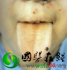 中医舌诊图解——淡白舌半黄半白苔_国医在线_guoyi163.com