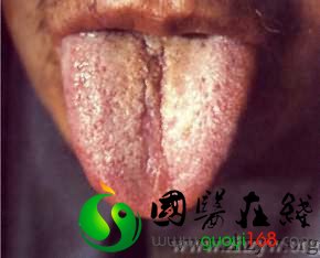 中医舌诊图解——暗红夹